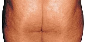 Cellulite vor Endermologie-Behandlung